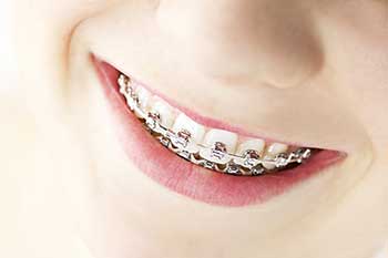 Braces in North Miami