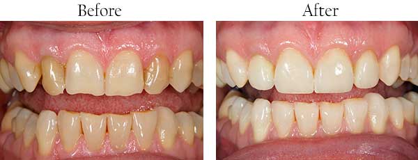 North Miami Beach Before and After Invisalign