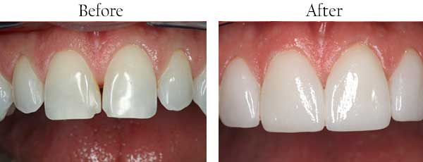 North Miami Before and After Teeth Whitening